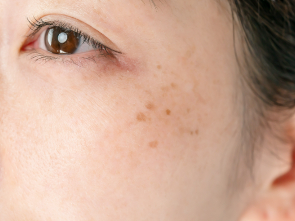 シミ取り・そばかす・肝斑治療